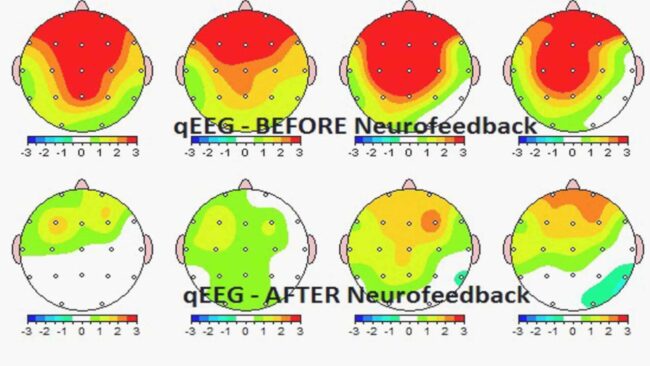 Neurofeedback For Migraines And NFB Protocol