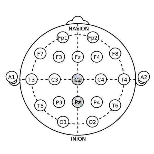 Alpha/Theta Training Protocol in Autism