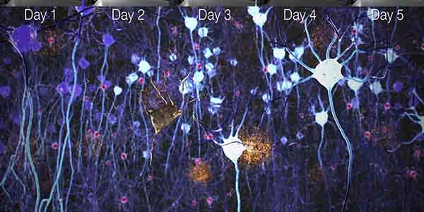 Due to Neuroplasticity, the Brain cells' activity is changed after Neuro VIZR flashing light therapy