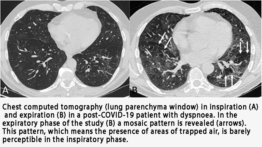 Chest CT (lung parenchyma window) in inspiration (A) and expiration (B) in a post-COVID-19 patient