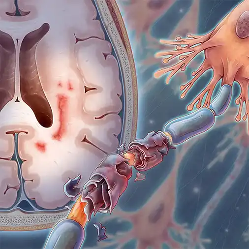 Demyelination - Nerve Damage in MS