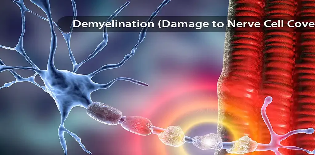 Demyelination damages nerve cells covering