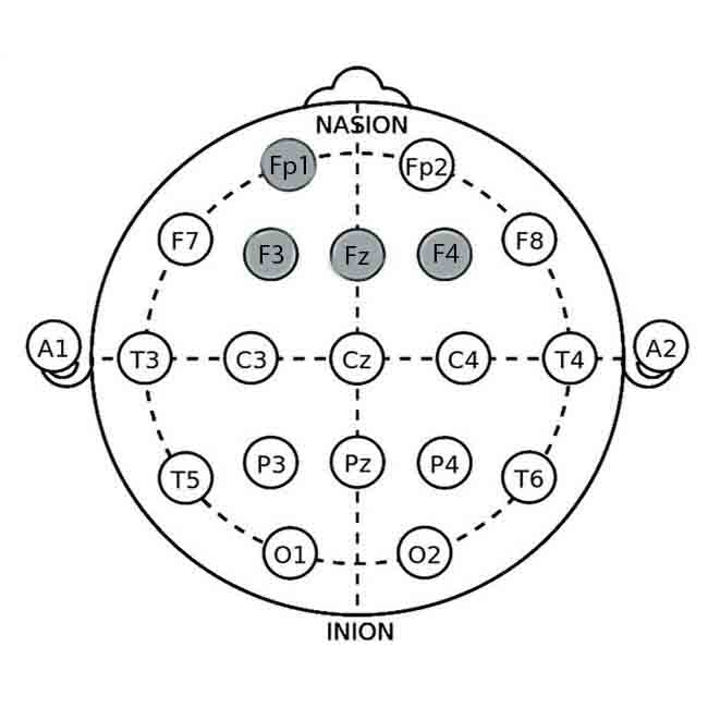 Electrode placement sites for Neurofeedback in Depression