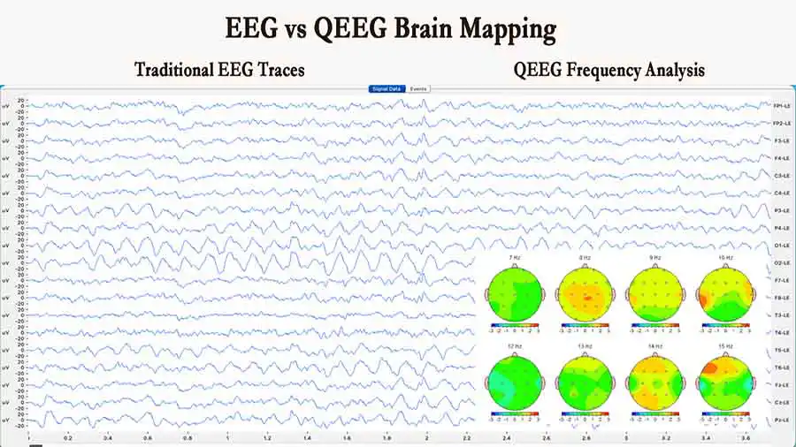 EEG vs qEEG Brain Mapping