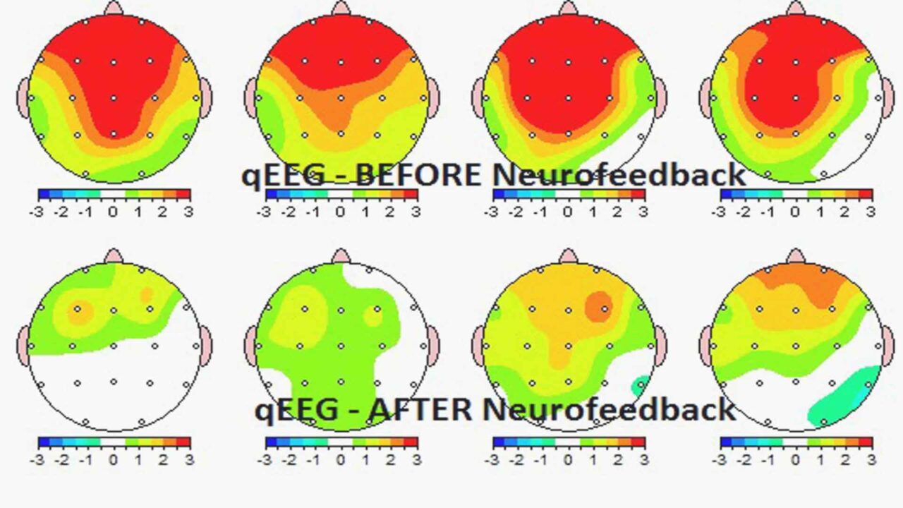 Effectiveness of Neurofeedback for Migraines