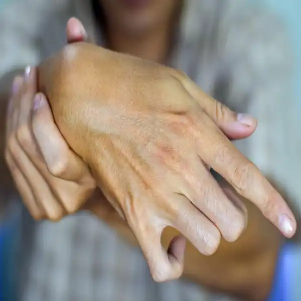 Hand Spasticity in Multiple Sclerosis