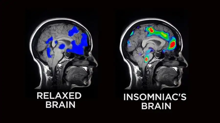 Insomnia Brain vs Normal Brain