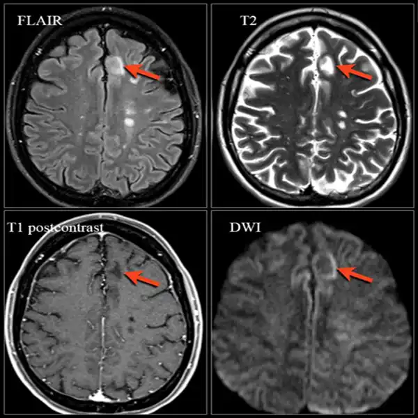 Brain Changes in MS
