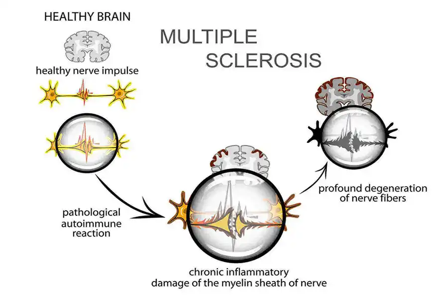 Brain Inflammation and MS
