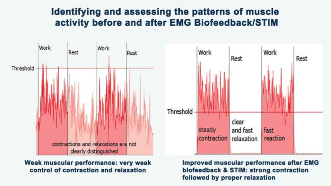 Emg Biofeedback Device When To Use And How To Choose