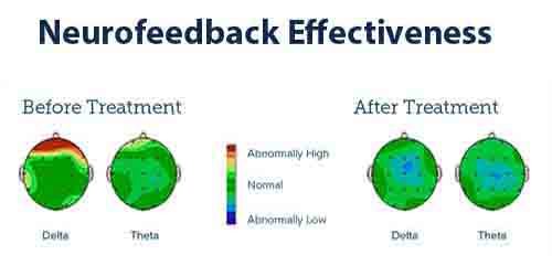 Effectiveness of Neurofeedback Autism Management