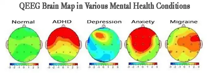 QEEG Brain Mapping in Various Mental Health Conditions