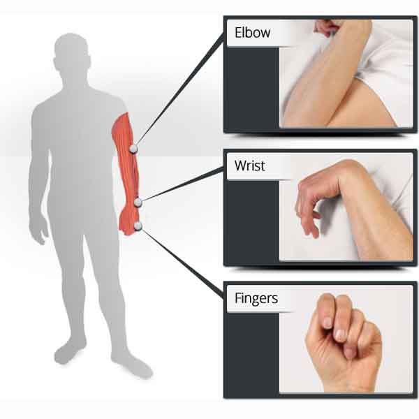 Spasticity arm