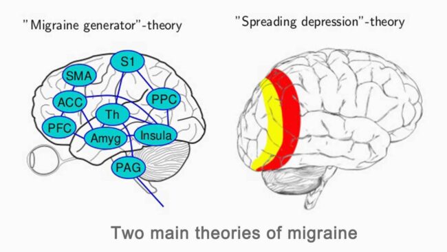 Neurofeedback Management of the Migraine and NFB Protocol