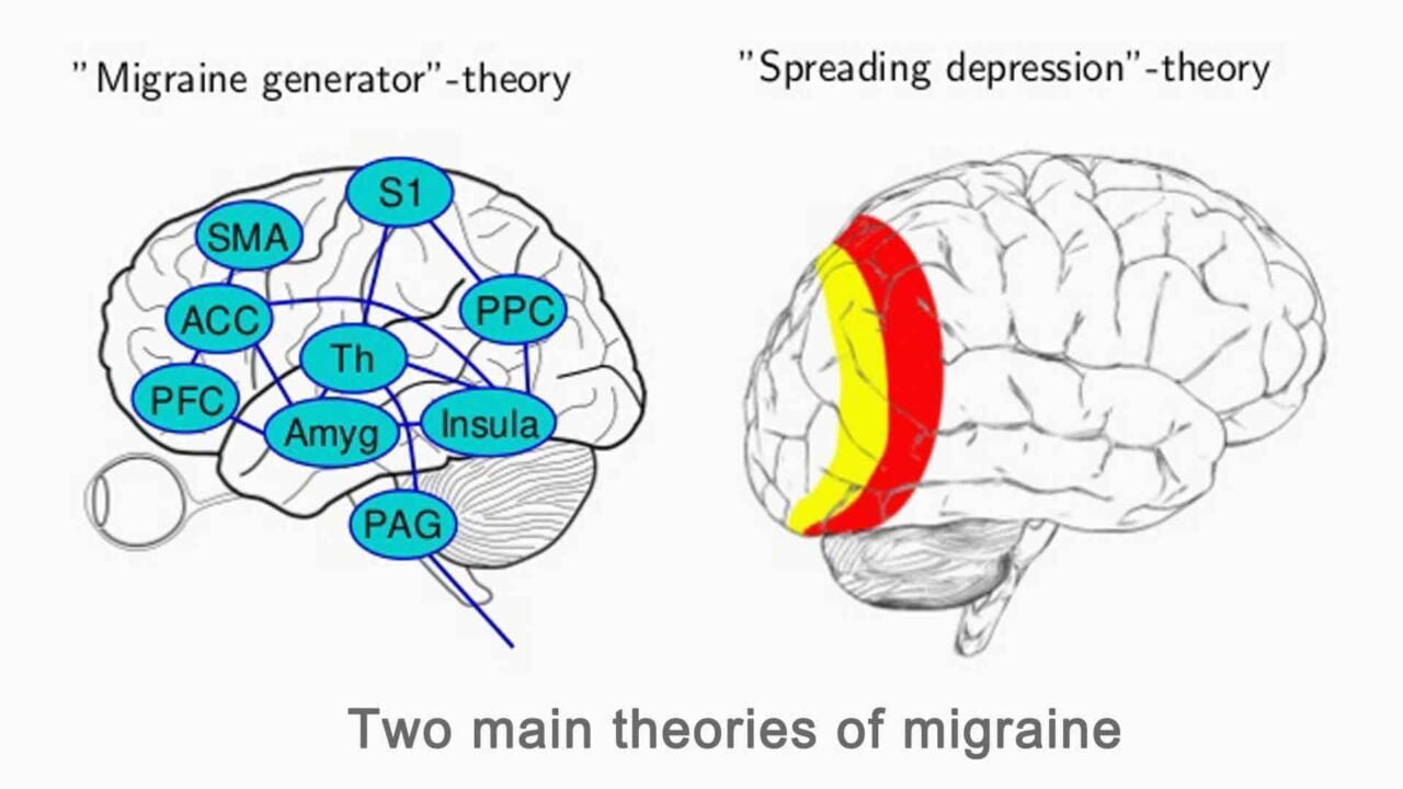 Two main theories of migraine