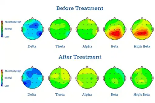 Autism: qEEG brain map before and after neurofeedback