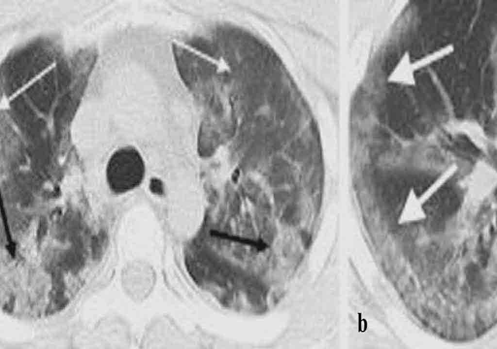 CT Scan of lung in COVID - pulmonary rehab exercises