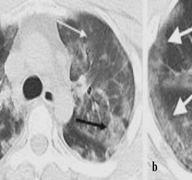 CT Scan of lung in COVID - pulmonary rehab exercises