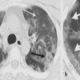 CT Scan of lung in COVID - pulmonary rehab exercises