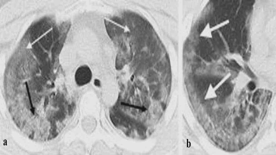 CT Scan of lung in COVID - pulmonary rehab exercises