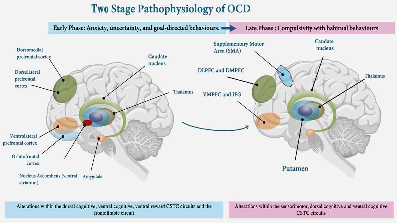 Two stage pathophysiology of OCD