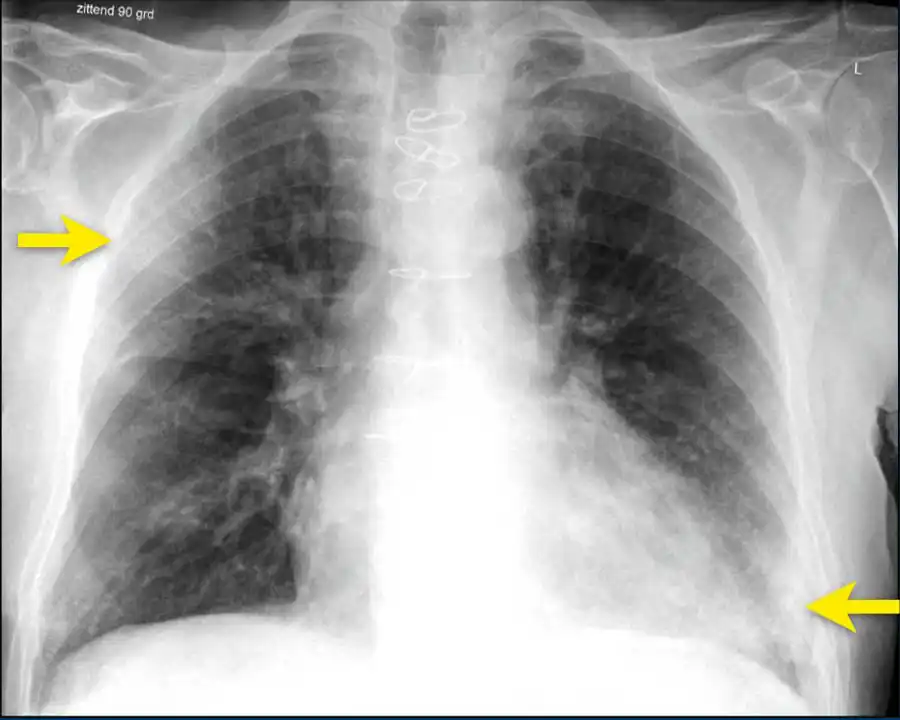 X-ray of the lung in COVID-19
